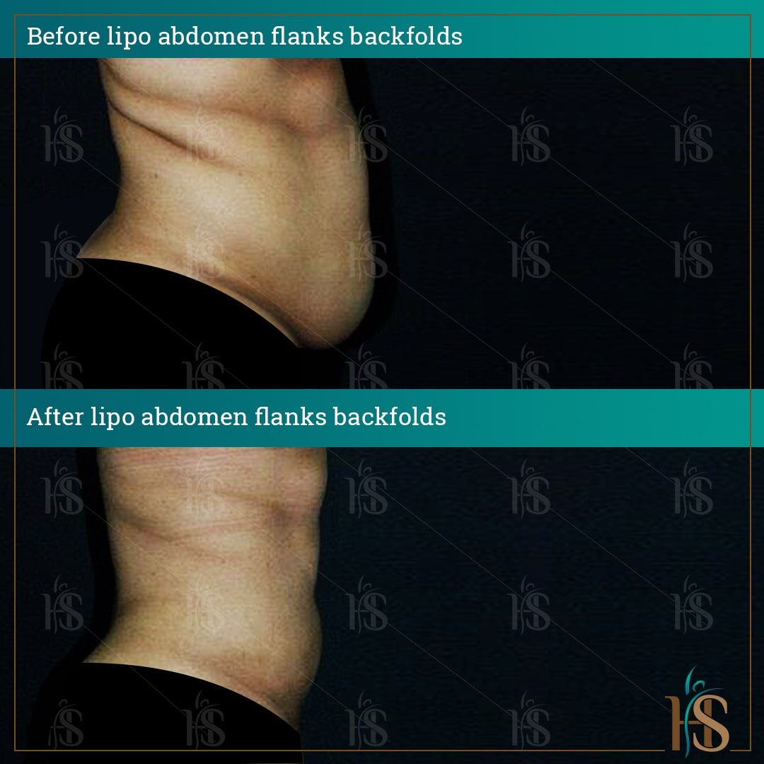VASER 4D Hi-Def Lipo of the Flank - Liposuction of the Flanks