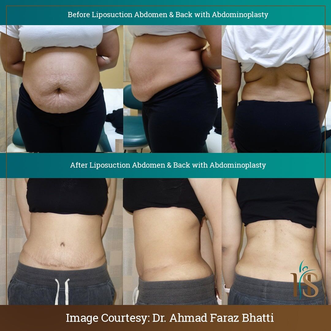 Looking for the Best Tummy Tuck Surgeon? — New You Harley Street