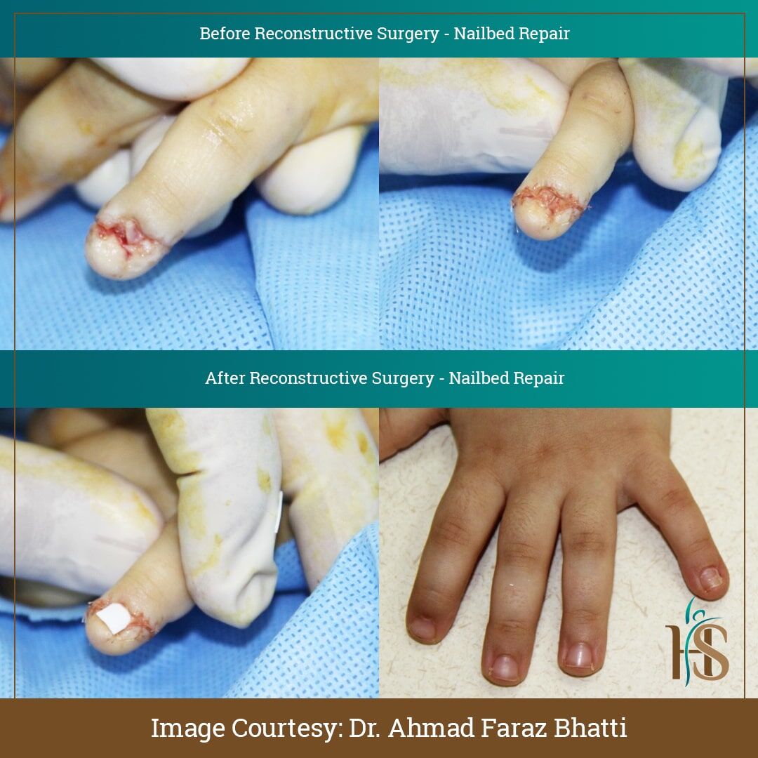 Nail Reconstruction With Nail Bed Graft From Big Toe: A Case Report