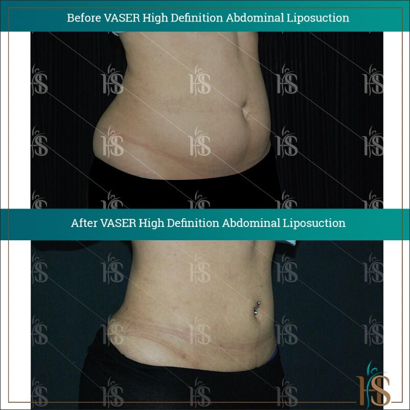 Liposuction in London  Top Liposuction Surgeon Dr. Hasan Ali